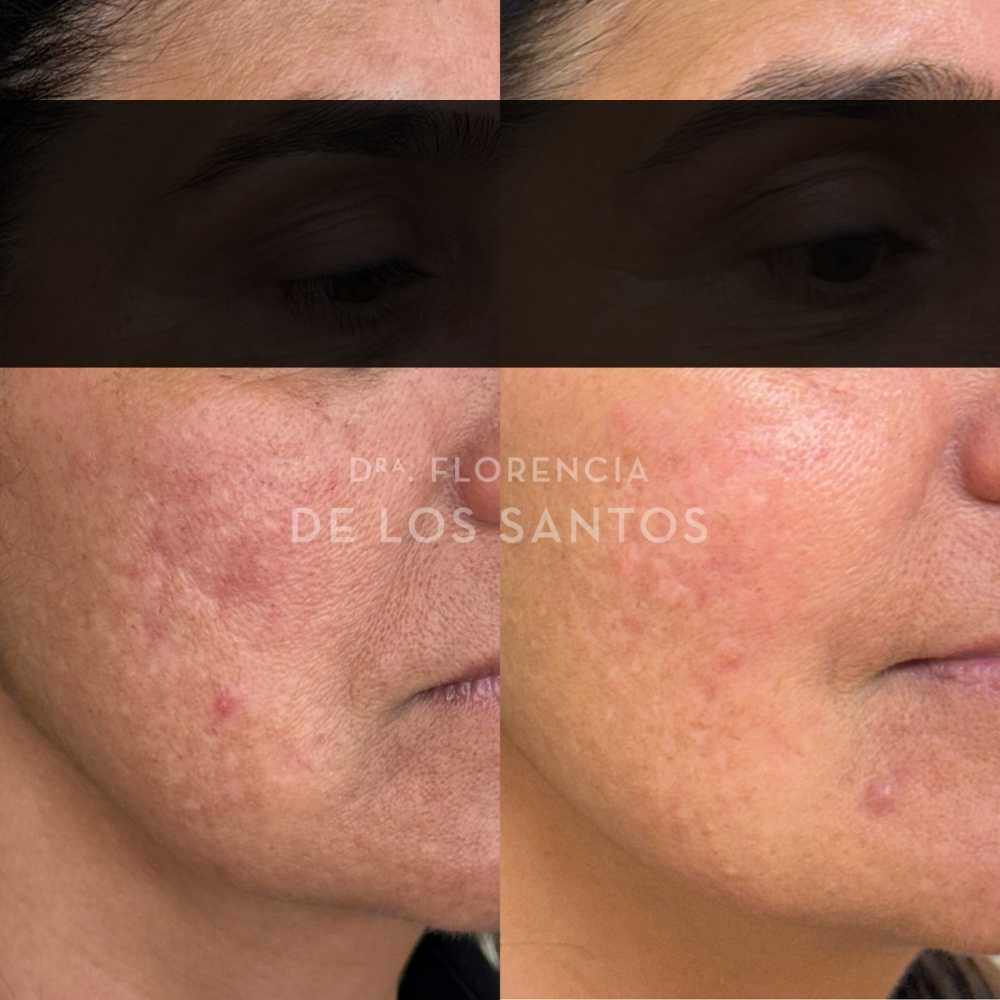 Cicatrices manchas medicliniq montevideo