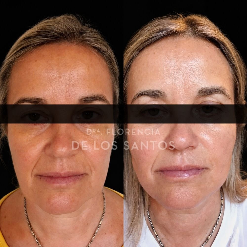 Hilos Tensors Dra Florencia de los Santos Medicliniq2