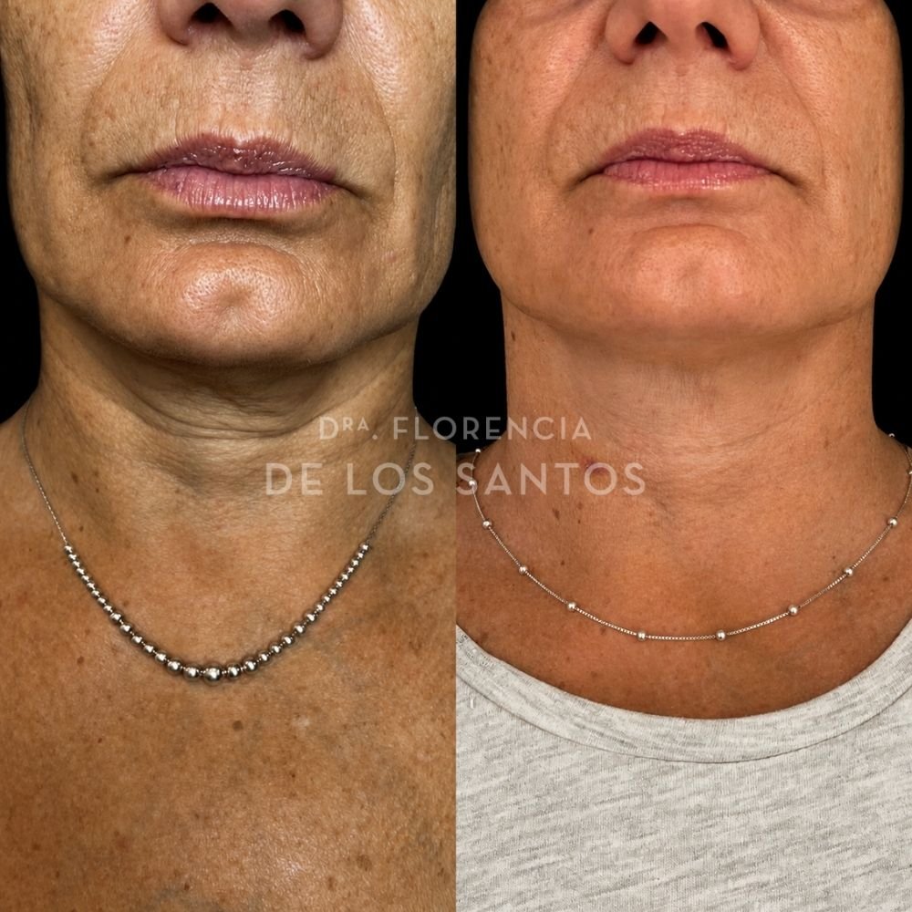 Hilos Tensors Dra Florencia de los Santos Medicliniq3