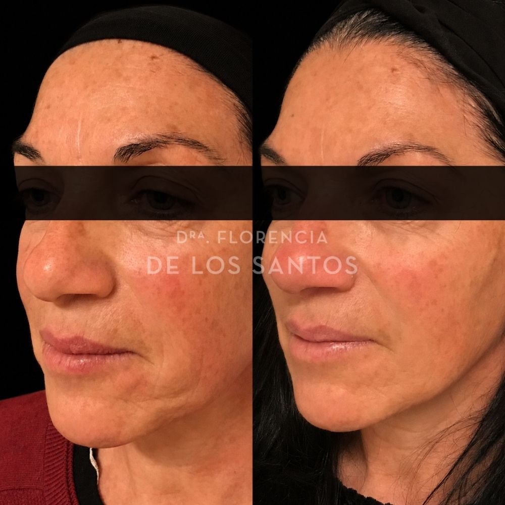 Hilos Tensors Dra Florencia de los Santos Medicliniq4