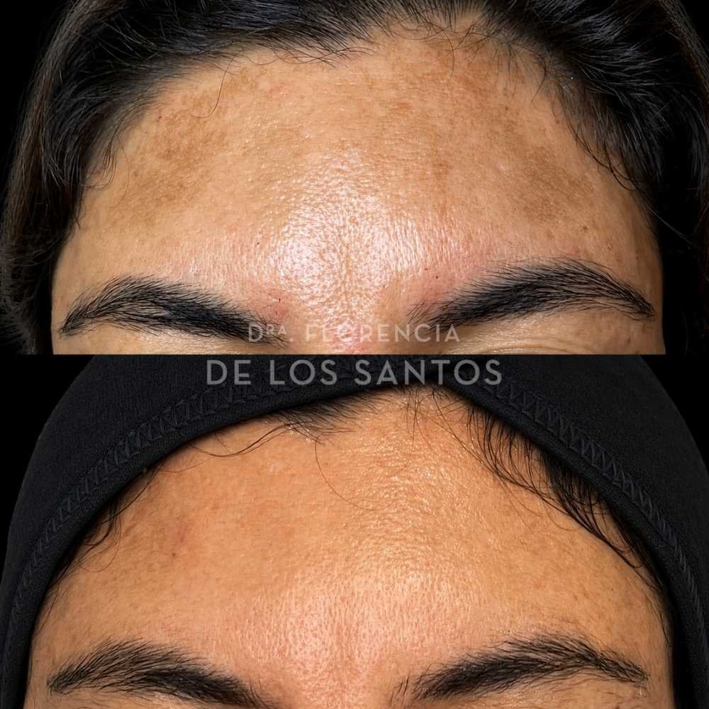 Manchas dra florencia de los santos tecnologia laser e ipl medicliniq1