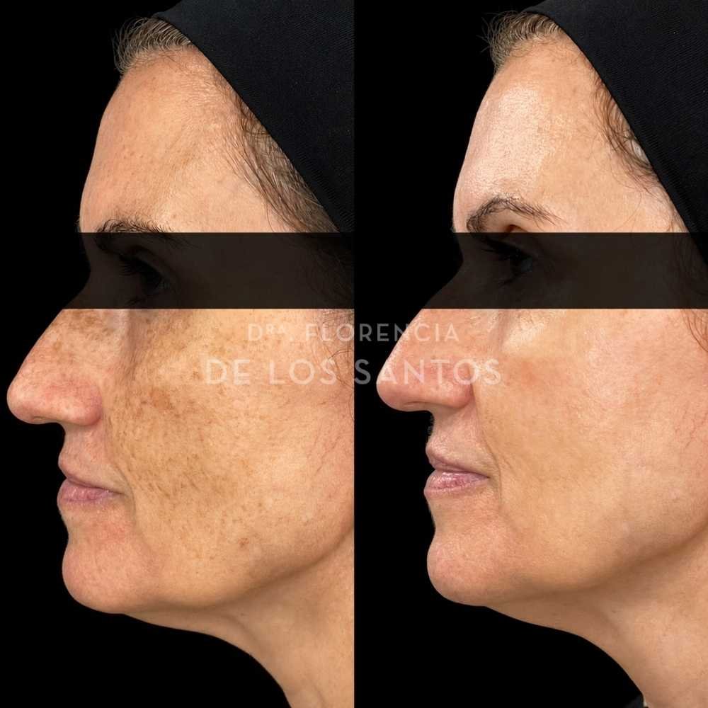 Manchas dra florencia de los santos tecnologia laser e ipl medicliniq10