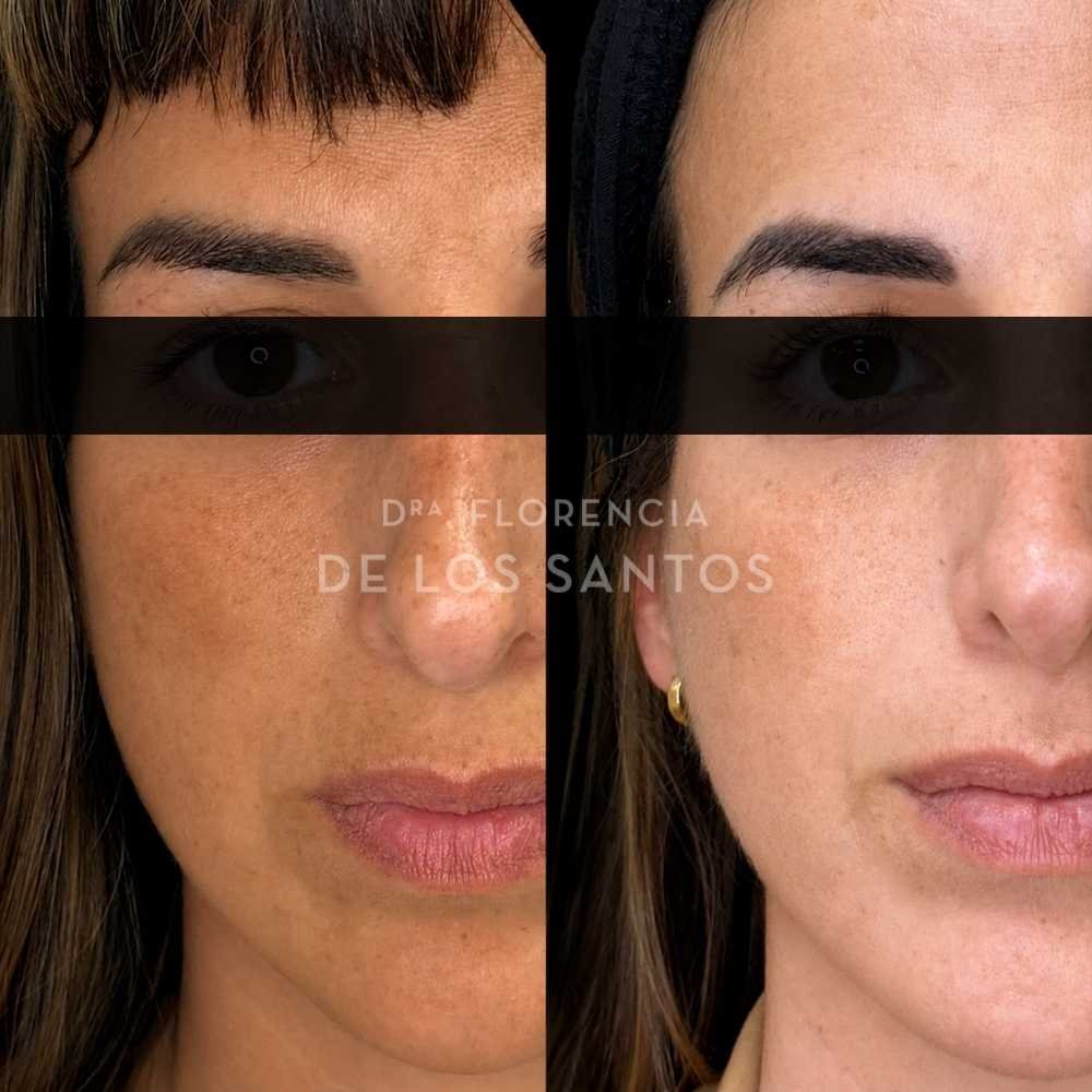 Manchas dra florencia de los santos tecnologia laser e ipl medicliniq11