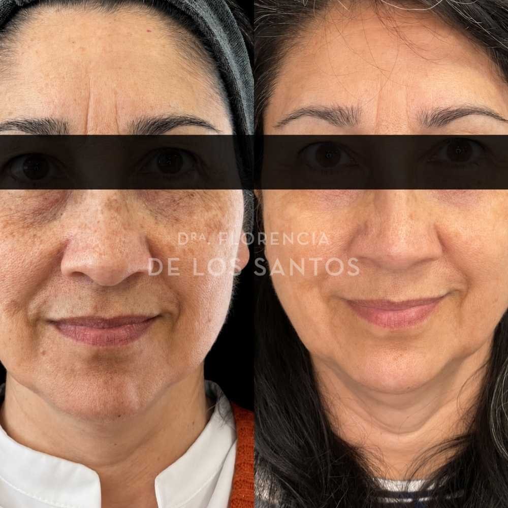 Manchas dra florencia de los santos tecnologia laser e ipl medicliniq12