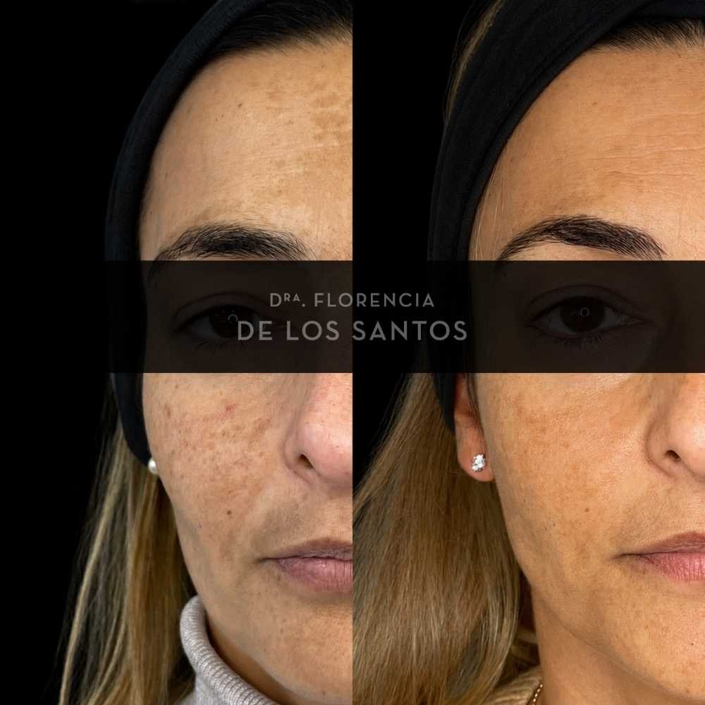 Manchas dra florencia de los santos tecnologia laser e ipl medicliniq2