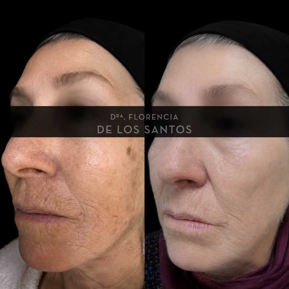 Manchas dra florencia de los santos tecnologia laser e ipl medicliniq3