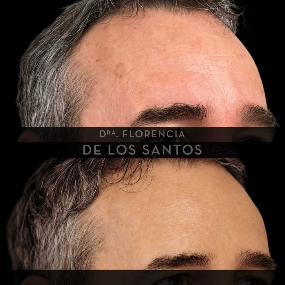Manchas dra florencia de los santos tecnologia laser e ipl medicliniq4