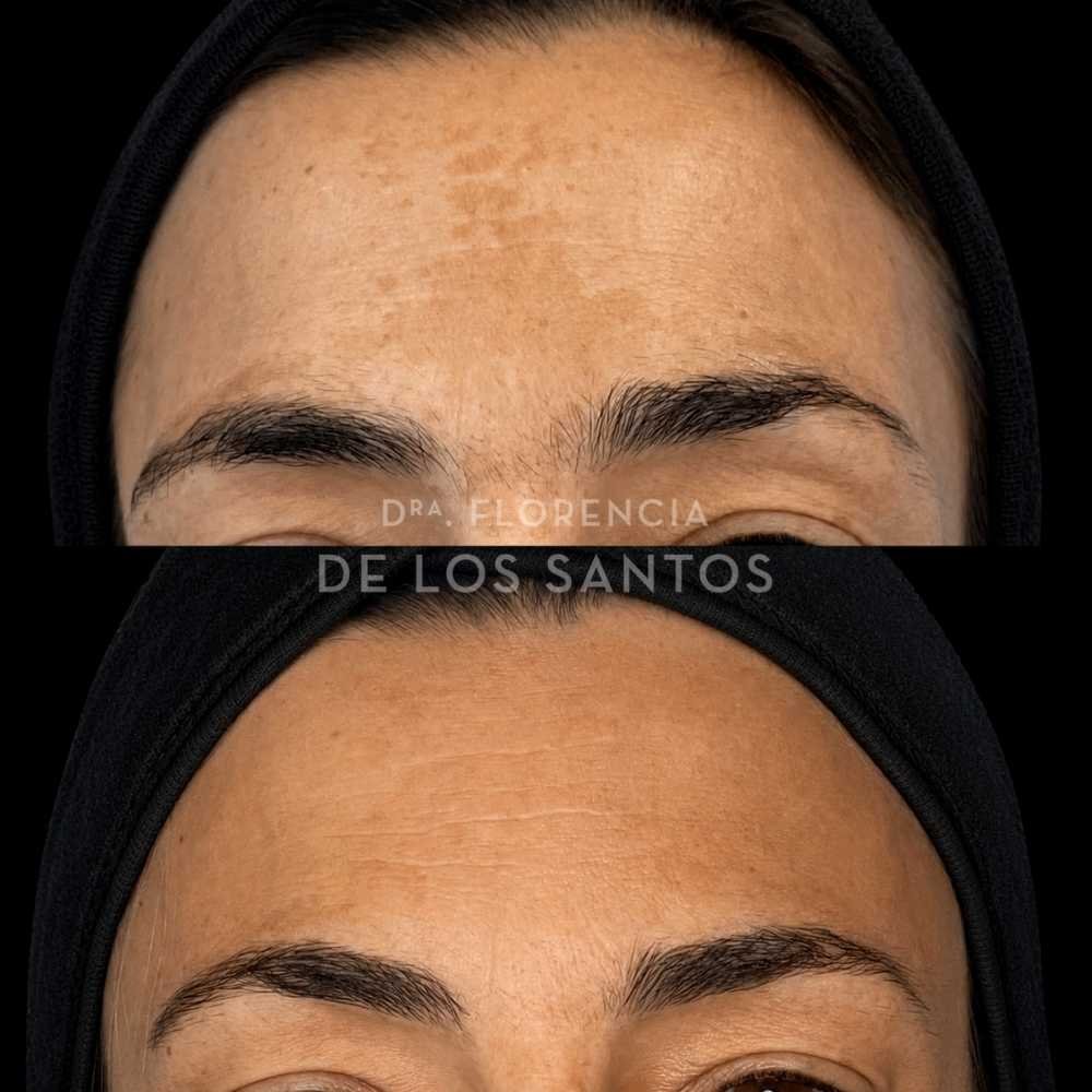 Manchas dra florencia de los santos tecnologia laser e ipl medicliniq5