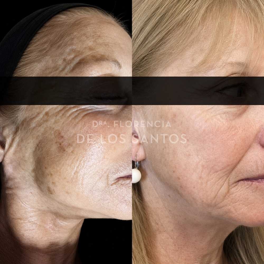 Manchas dra florencia de los santos tecnologia laser e ipl medicliniq6