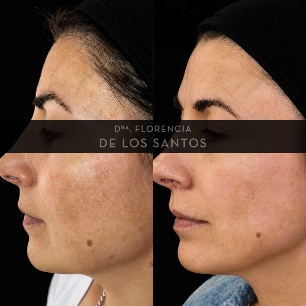 Manchas dra florencia de los santos tecnologia laser e ipl medicliniq7