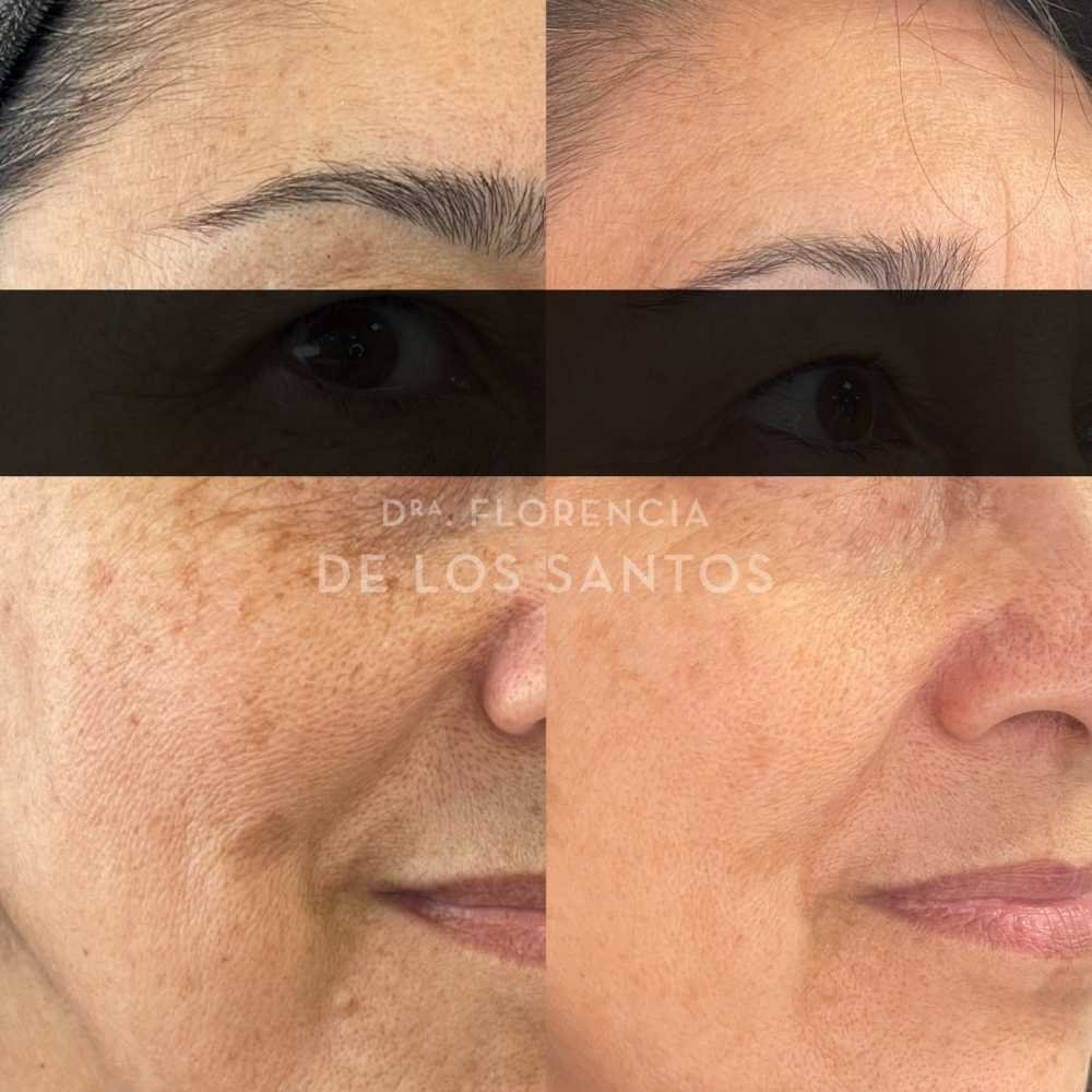 Manchas dra florencia de los santos tecnologia laser e ipl medicliniq8