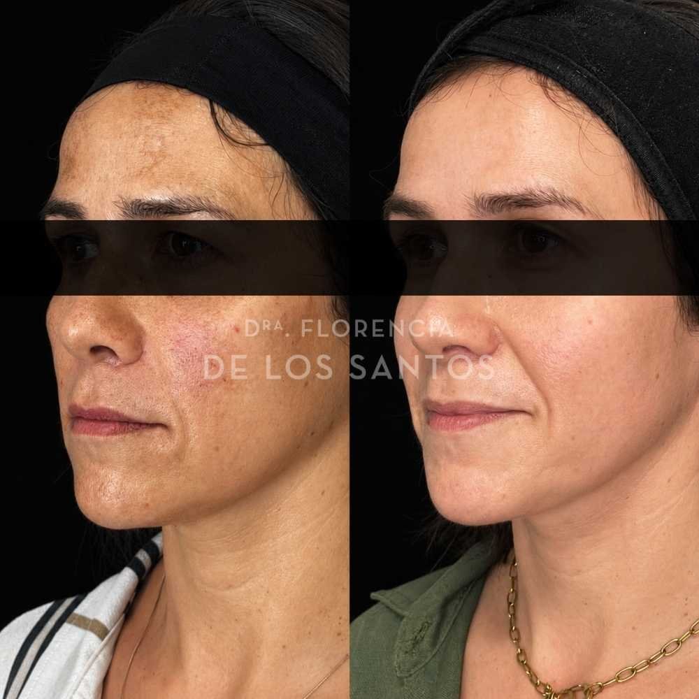 Manchas dra florencia de los santos tecnologia laser e ipl medicliniq9