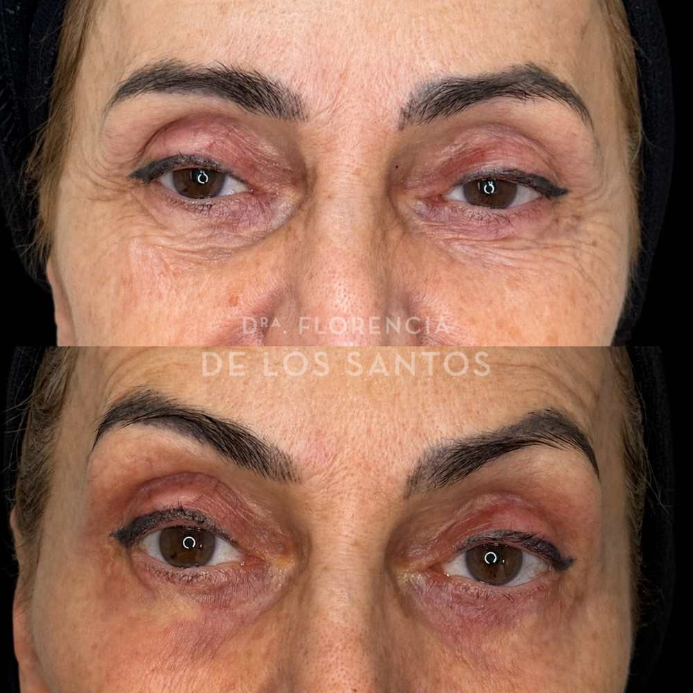 Parpados medicliniq montevideo