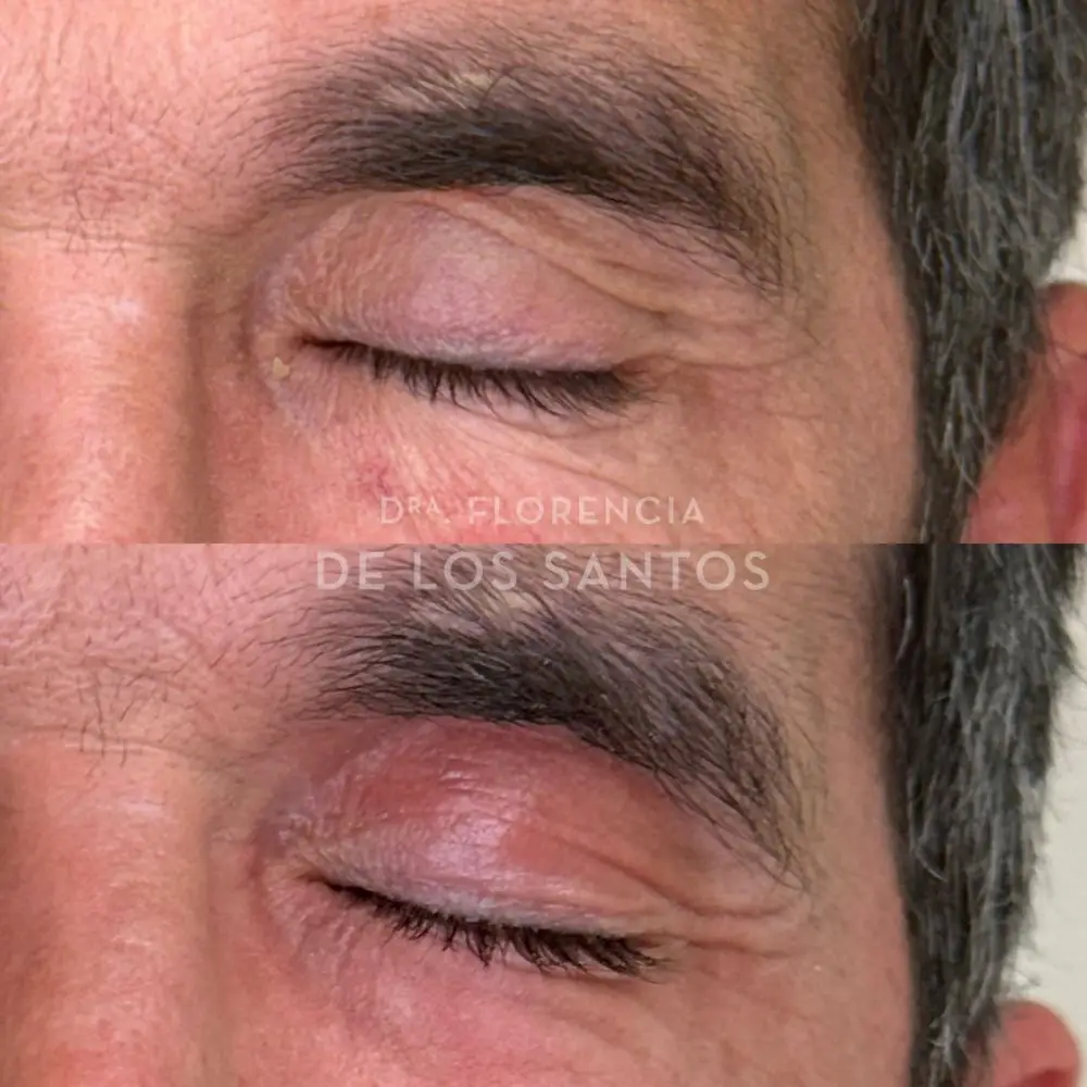 Rejuvenecimiento de párpados laser Dra Florencia de los Santos Medicliniq4 (1)