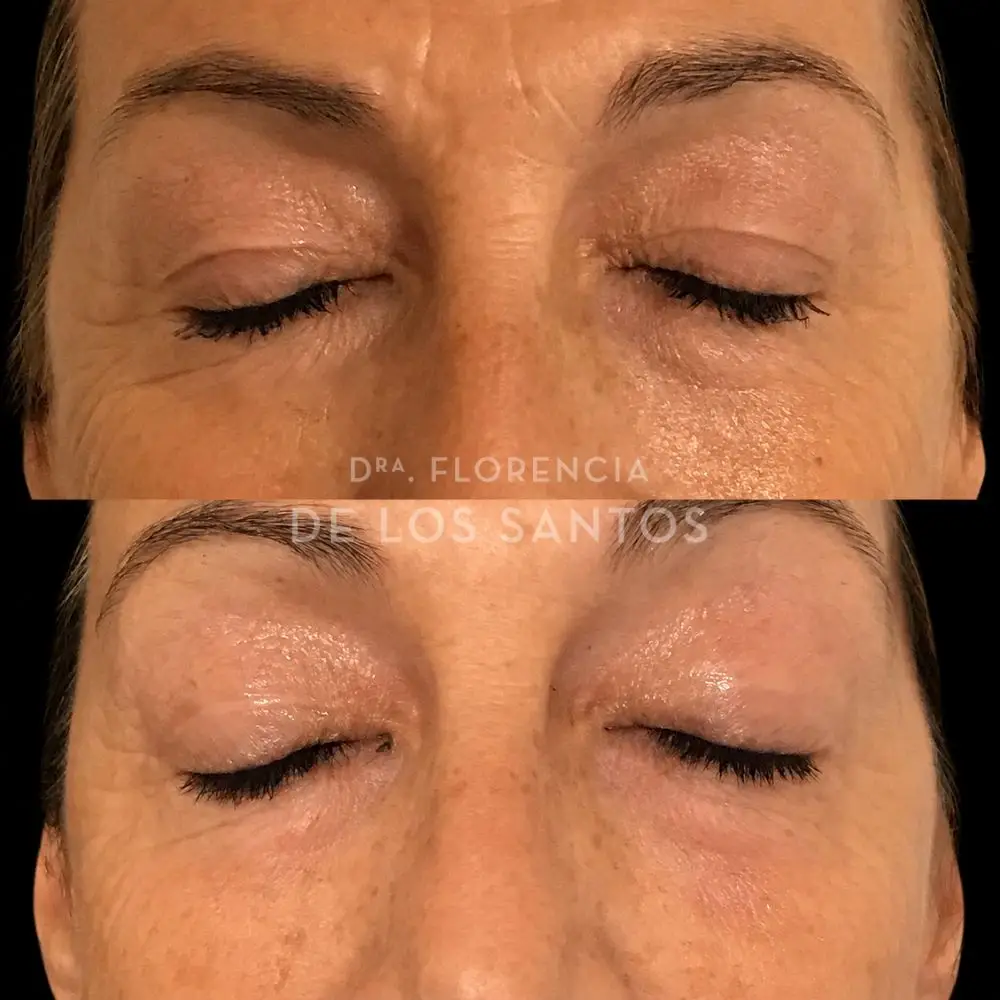 Rejuvenecimiento de párpados laser Dra Florencia de los Santos Medicliniq4 (2)