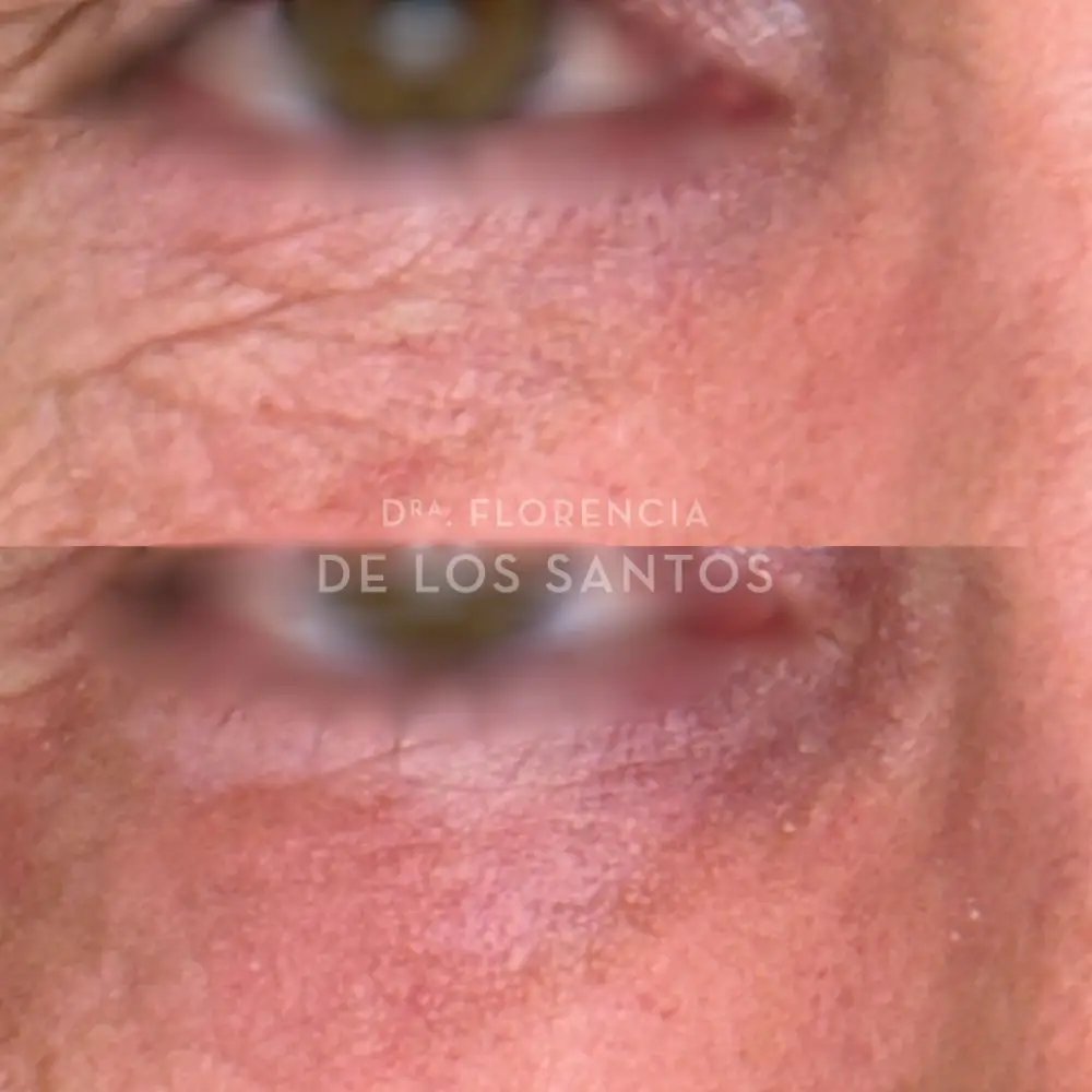 Rejuvenecimiento de párpados laser Dra Florencia de los Santos Medicliniq4 (3)