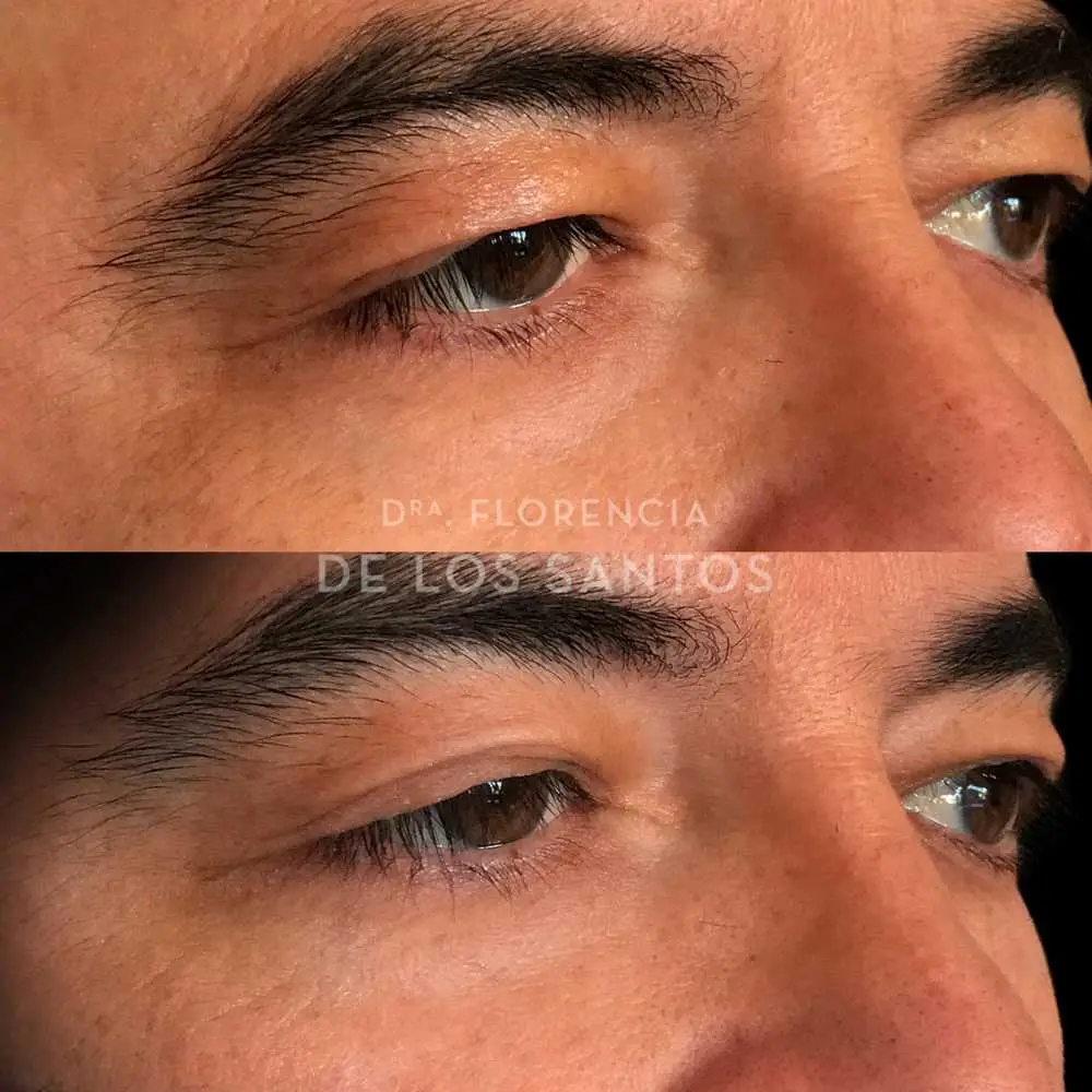 Rejuvenecimiento de párpados laser Dra Florencia de los Santos Medicliniq4