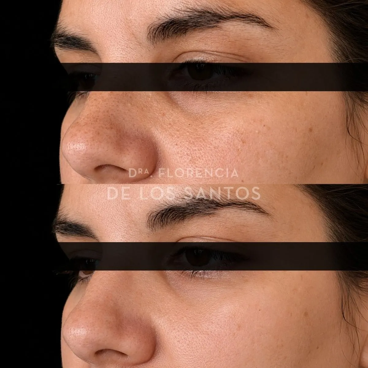 Relleno de Ojeras Dra Florencia de los Santos Medicliniq1