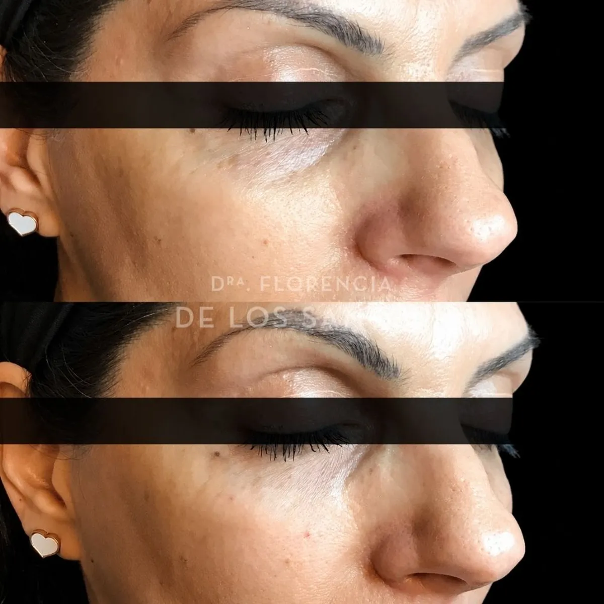 Relleno de Ojeras Dra Florencia de los Santos Medicliniq10