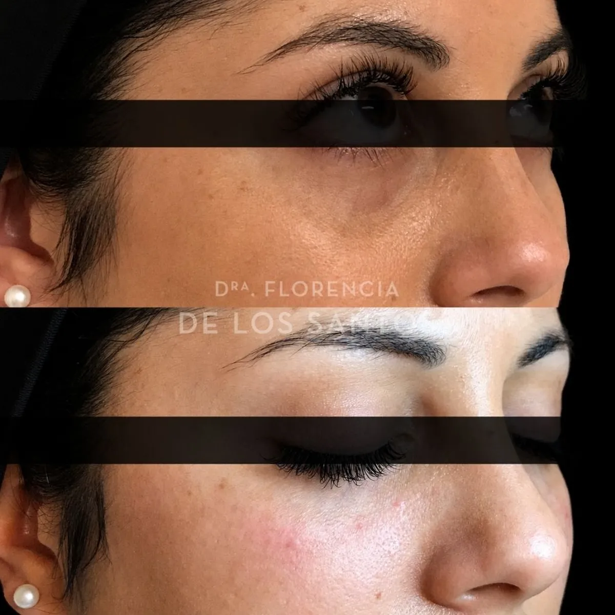 Relleno de Ojeras Dra Florencia de los Santos Medicliniq11