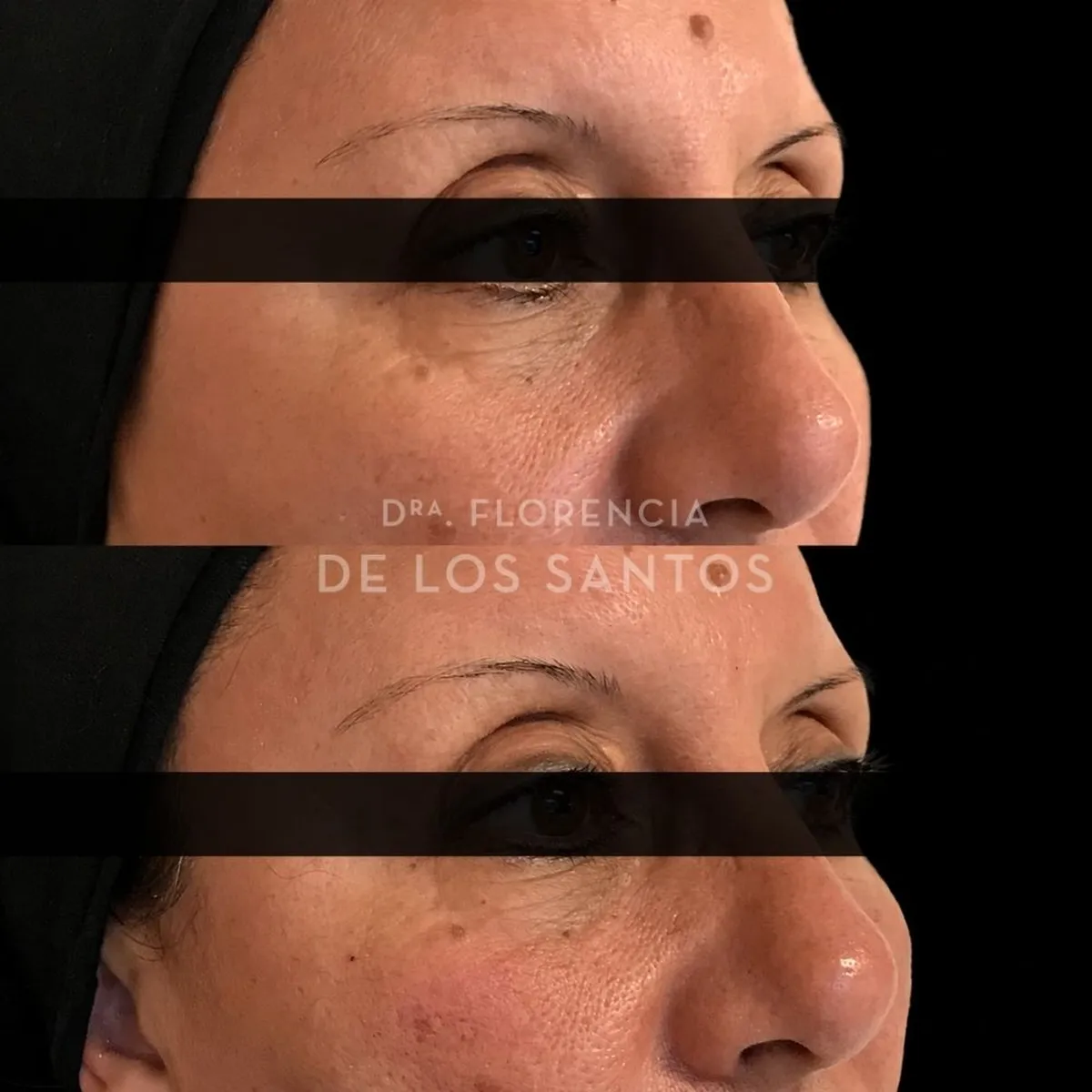 Relleno de Ojeras Dra Florencia de los Santos Medicliniq12