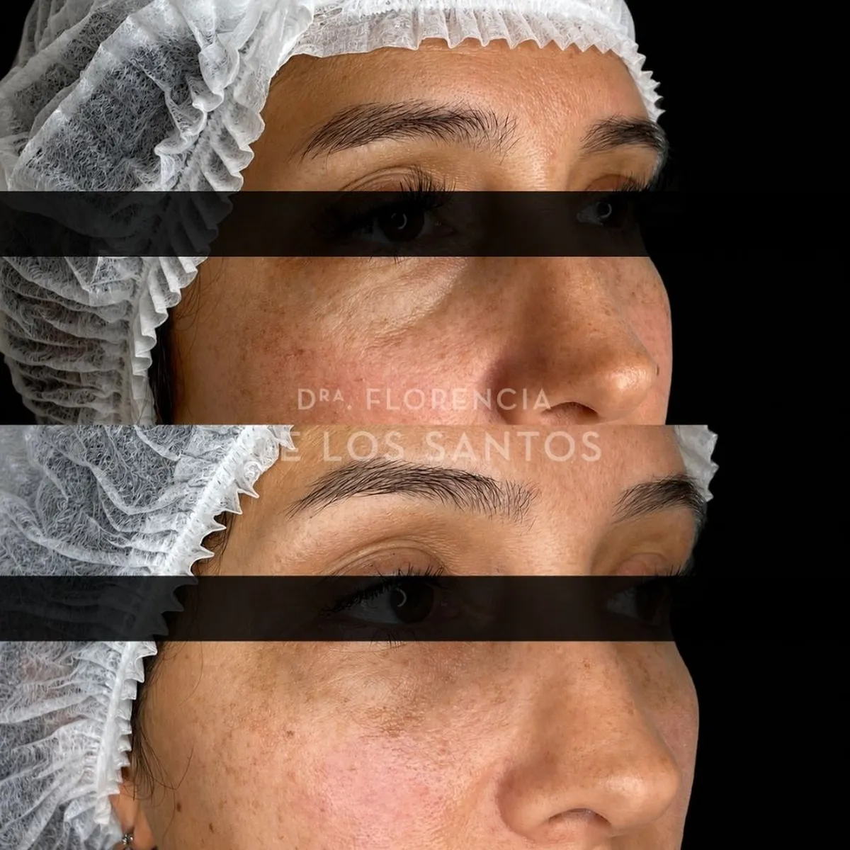 Relleno de Ojeras Dra Florencia de los Santos Medicliniq13