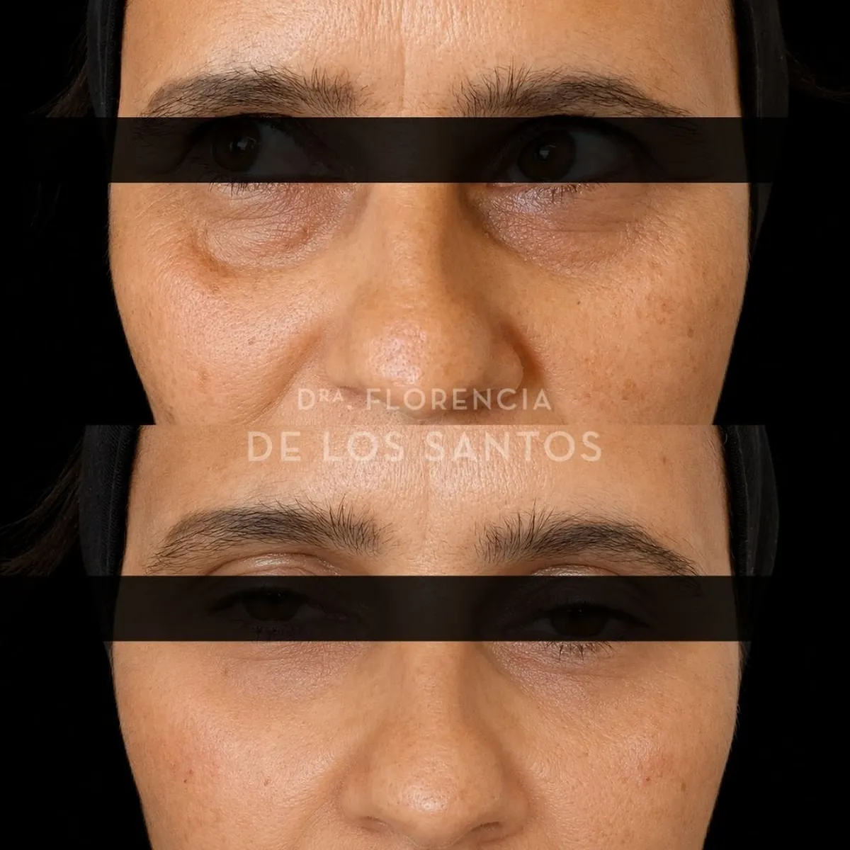Relleno de Ojeras Dra Florencia de los Santos Medicliniq2