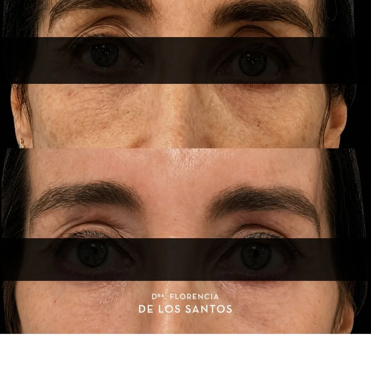 Relleno de Ojeras Dra Florencia de los Santos Medicliniq3