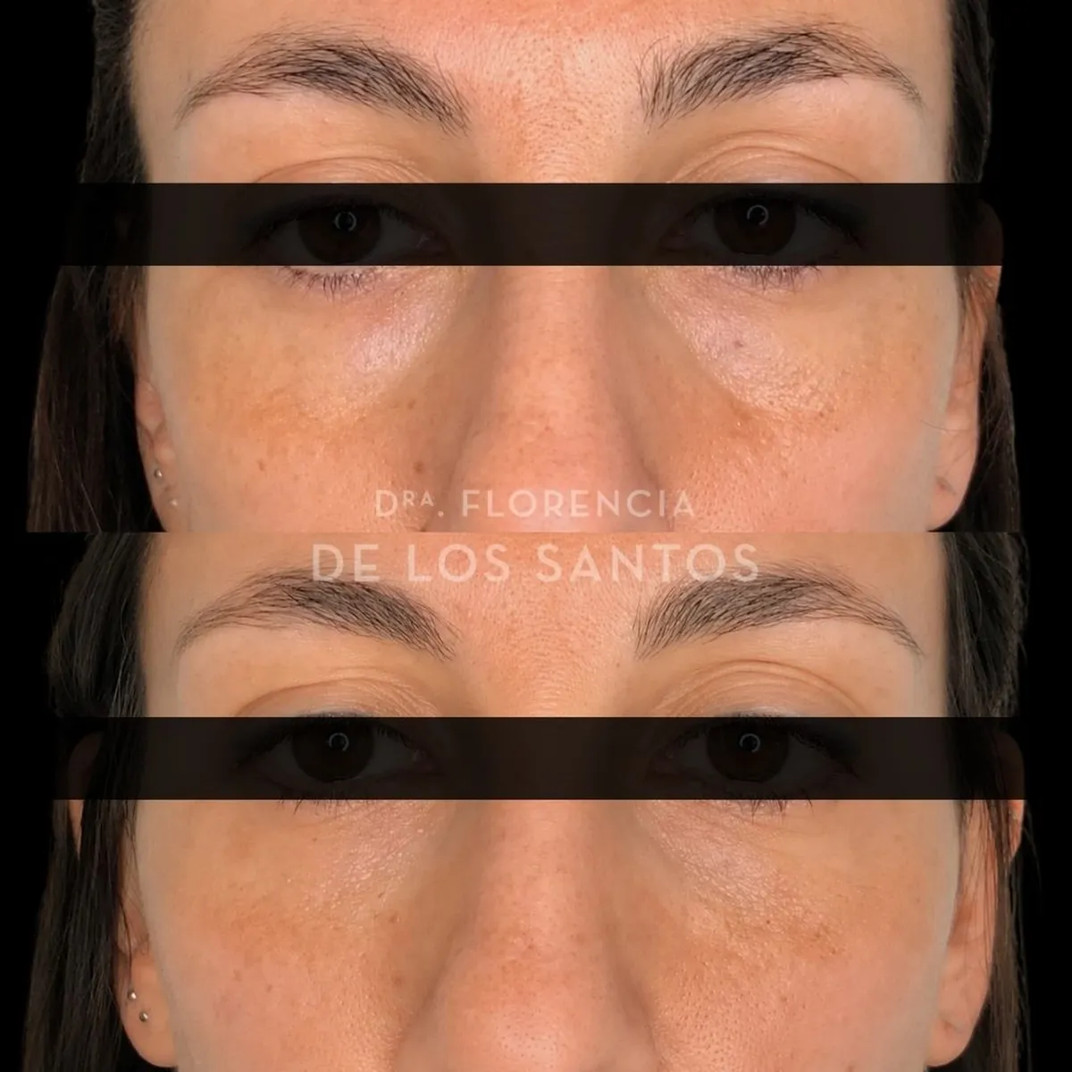 Relleno de Ojeras Dra Florencia de los Santos Medicliniq4