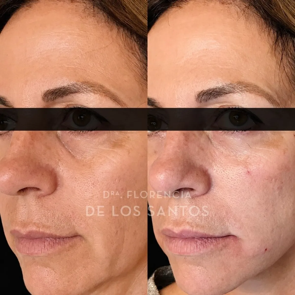 Relleno de Ojeras Dra Florencia de los Santos Medicliniq5