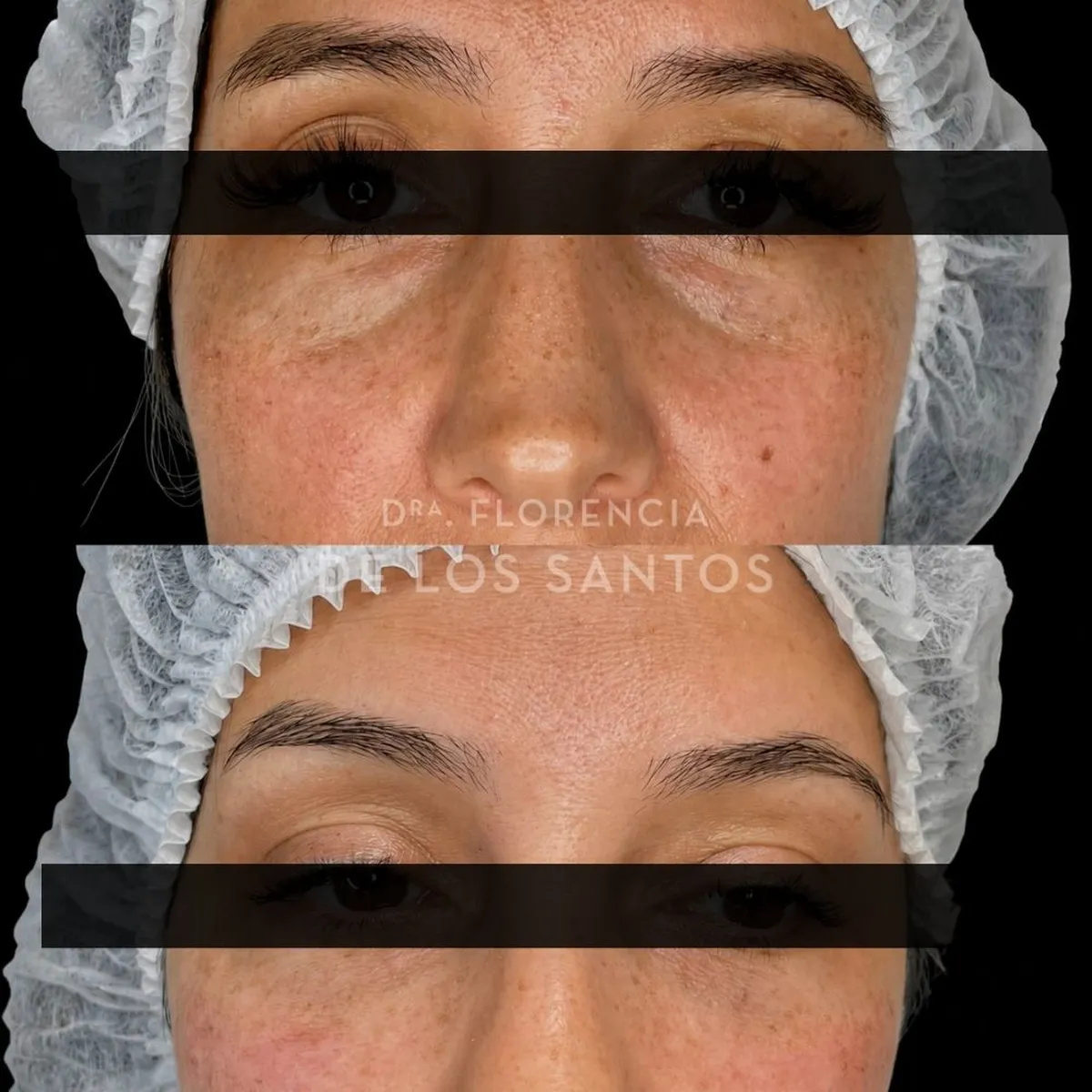 Relleno de Ojeras Dra Florencia de los Santos Medicliniq6