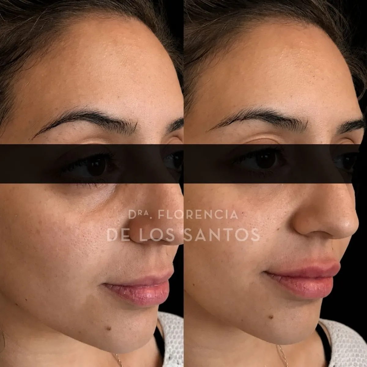 Relleno de Ojeras Dra Florencia de los Santos Medicliniq7