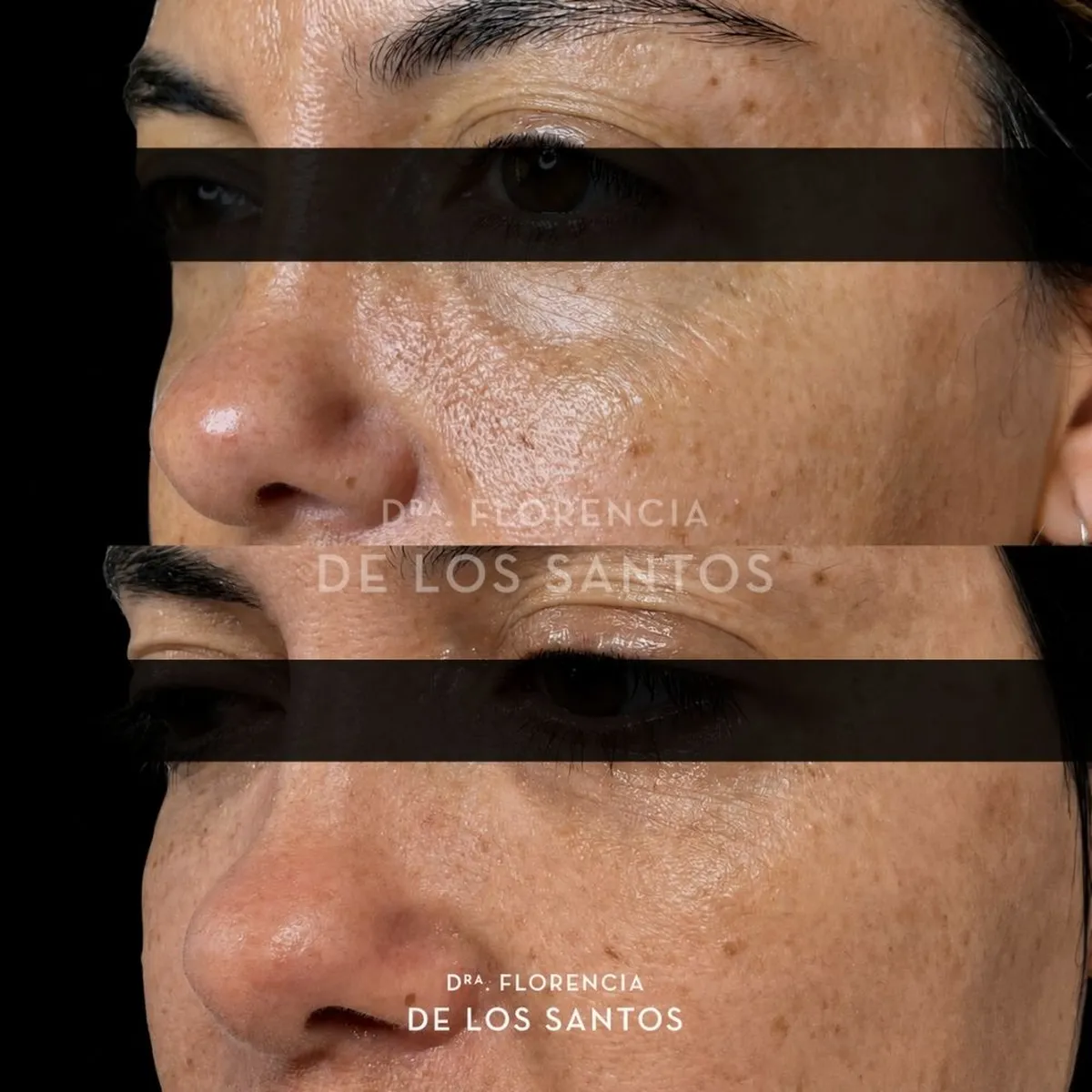 Relleno de Ojeras Dra Florencia de los Santos Medicliniq8