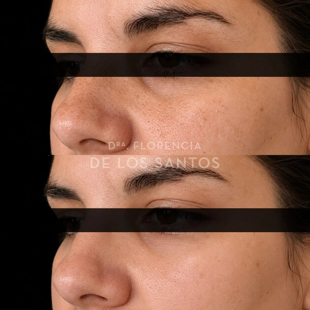 Relleno de Ojeras Dra Florencia de los Santos Medicliniq9