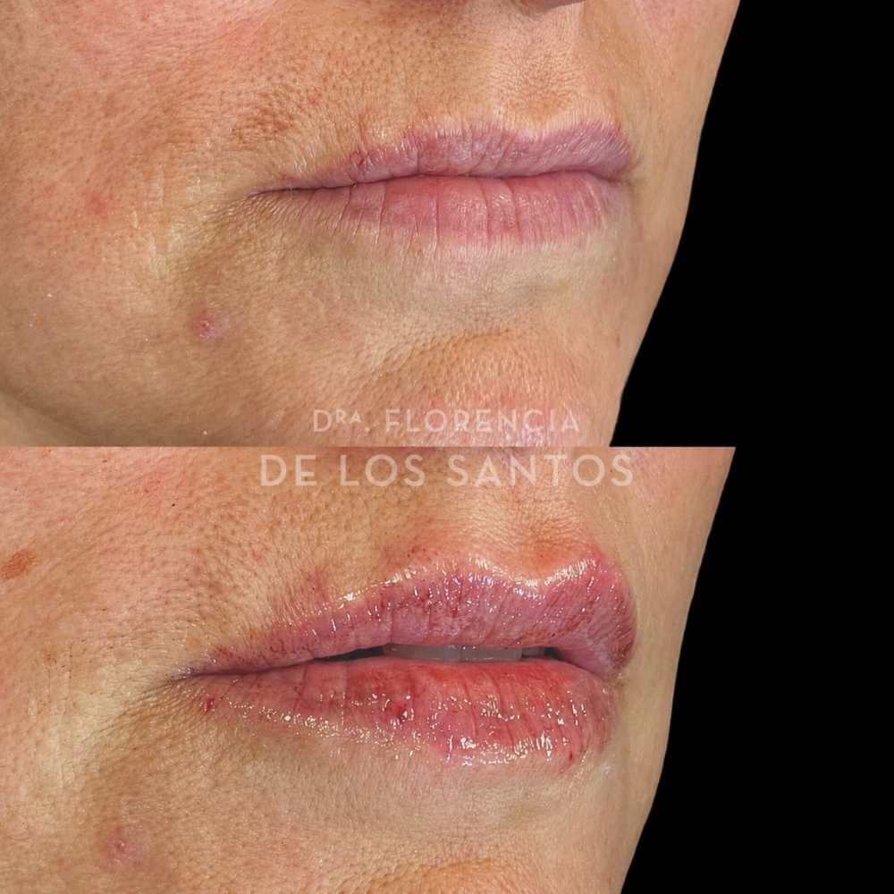 Relleno e hidratación labios acido hialurónico Dra Florencia de los Santos Medicliniq18