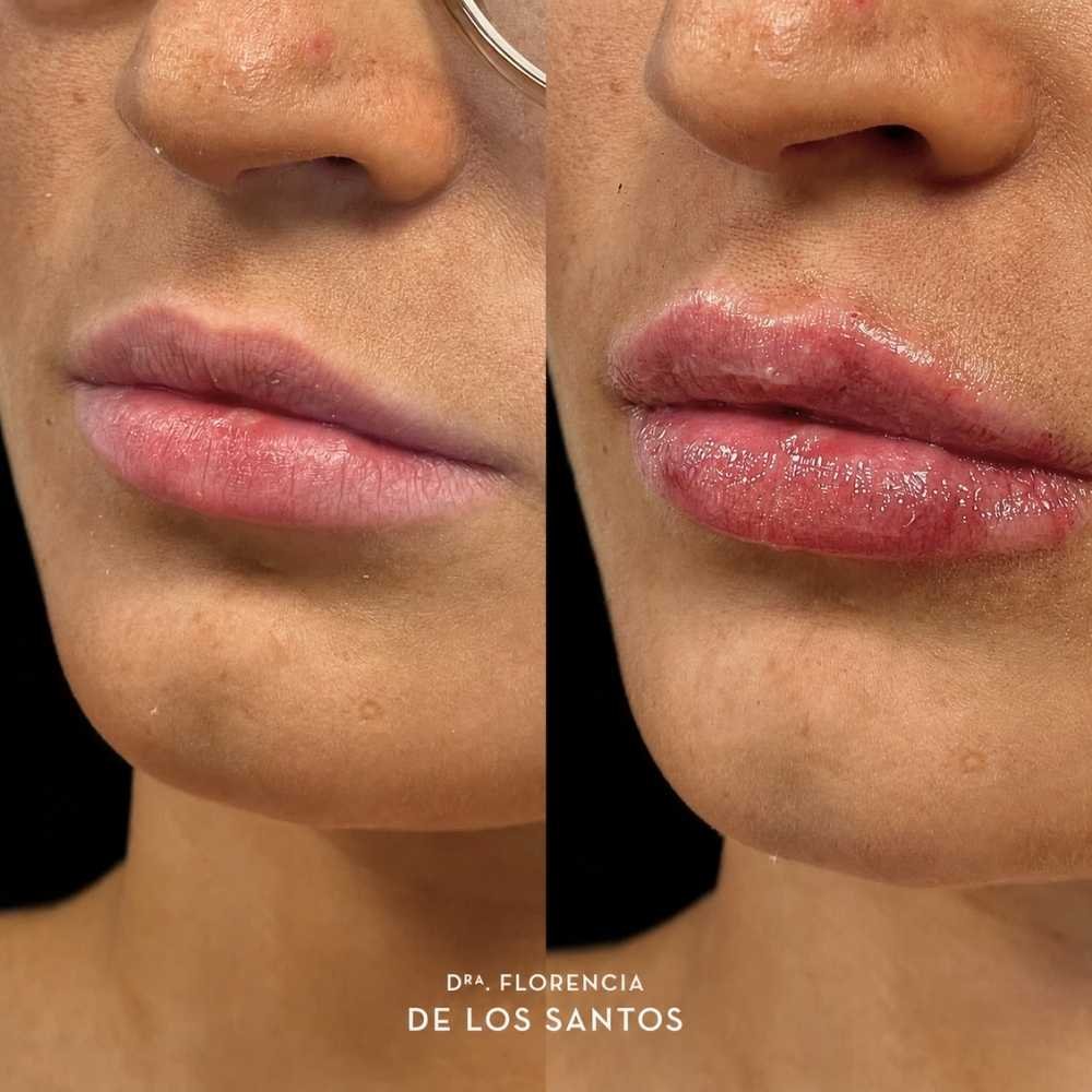 Relleno e hidratación labios acido hialurónico Dra Florencia de los Santos Medicliniq19