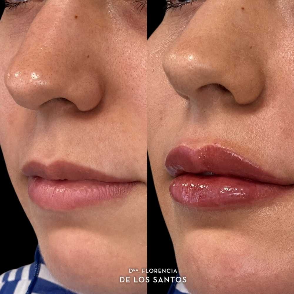 Relleno e hidratación labios acido hialurónico Dra Florencia de los Santos Medicliniq20