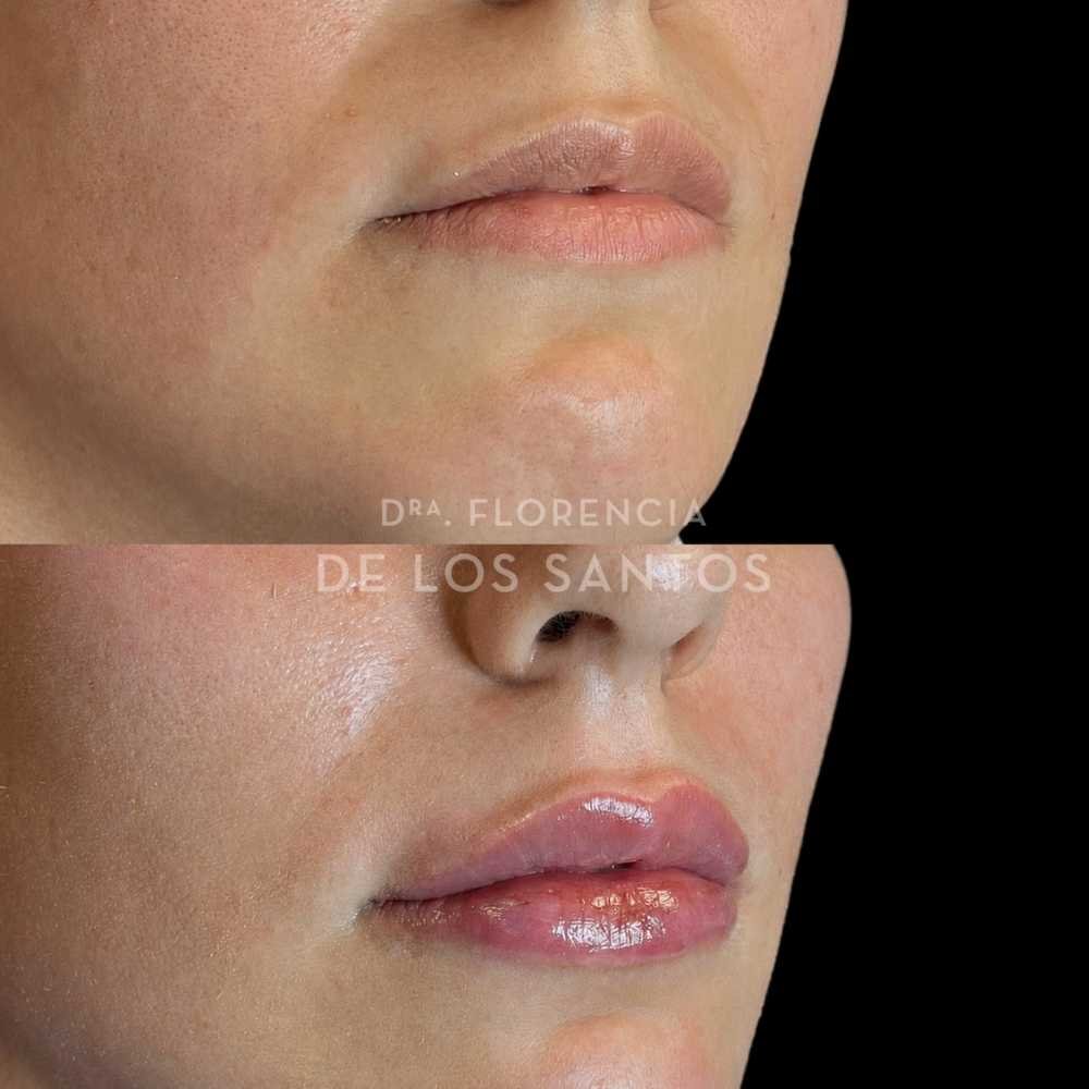 Relleno e hidratación labios acido hialurónico Dra Florencia de los Santos Medicliniq21