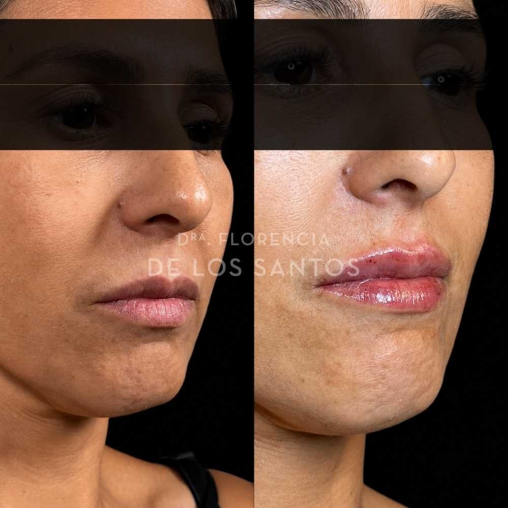 Relleno e hidratación labios acido hialurónico Dra Florencia de los Santos Medicliniq22