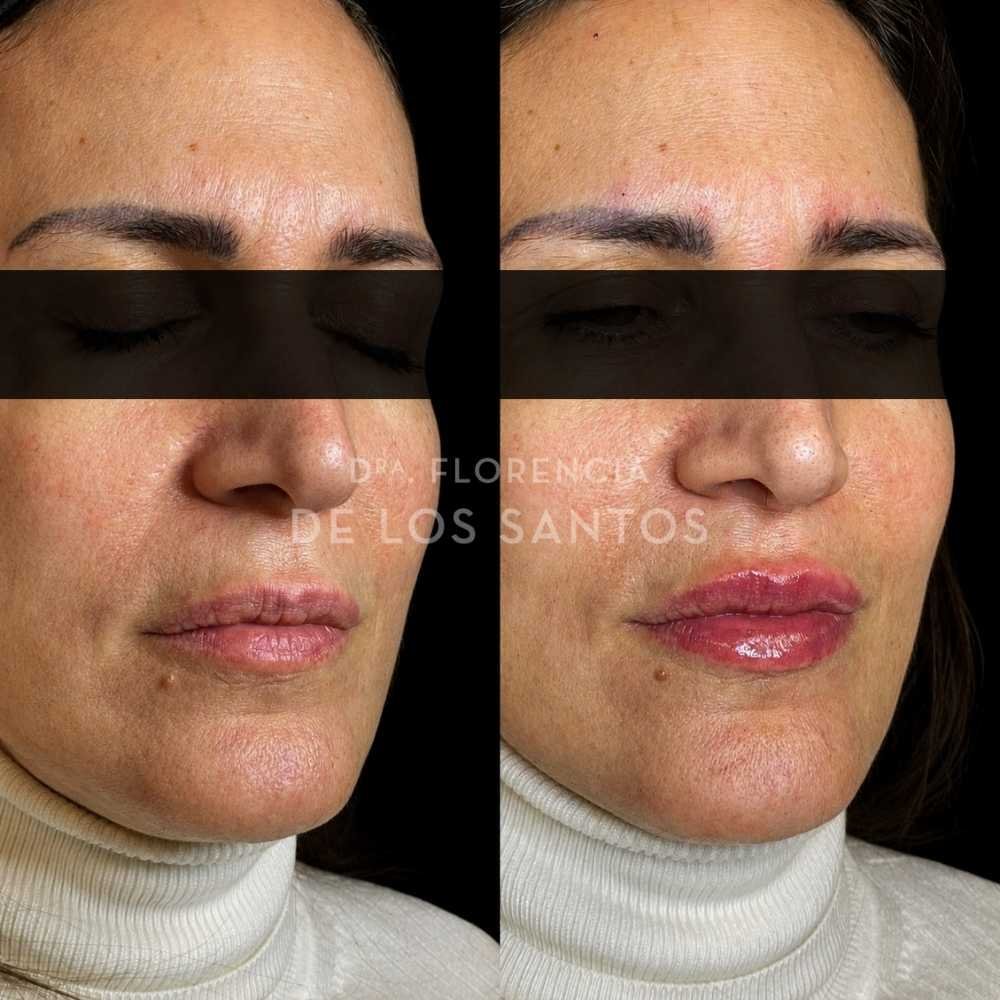 Relleno e hidratación labios acido hialurónico Dra Florencia de los Santos Medicliniq23