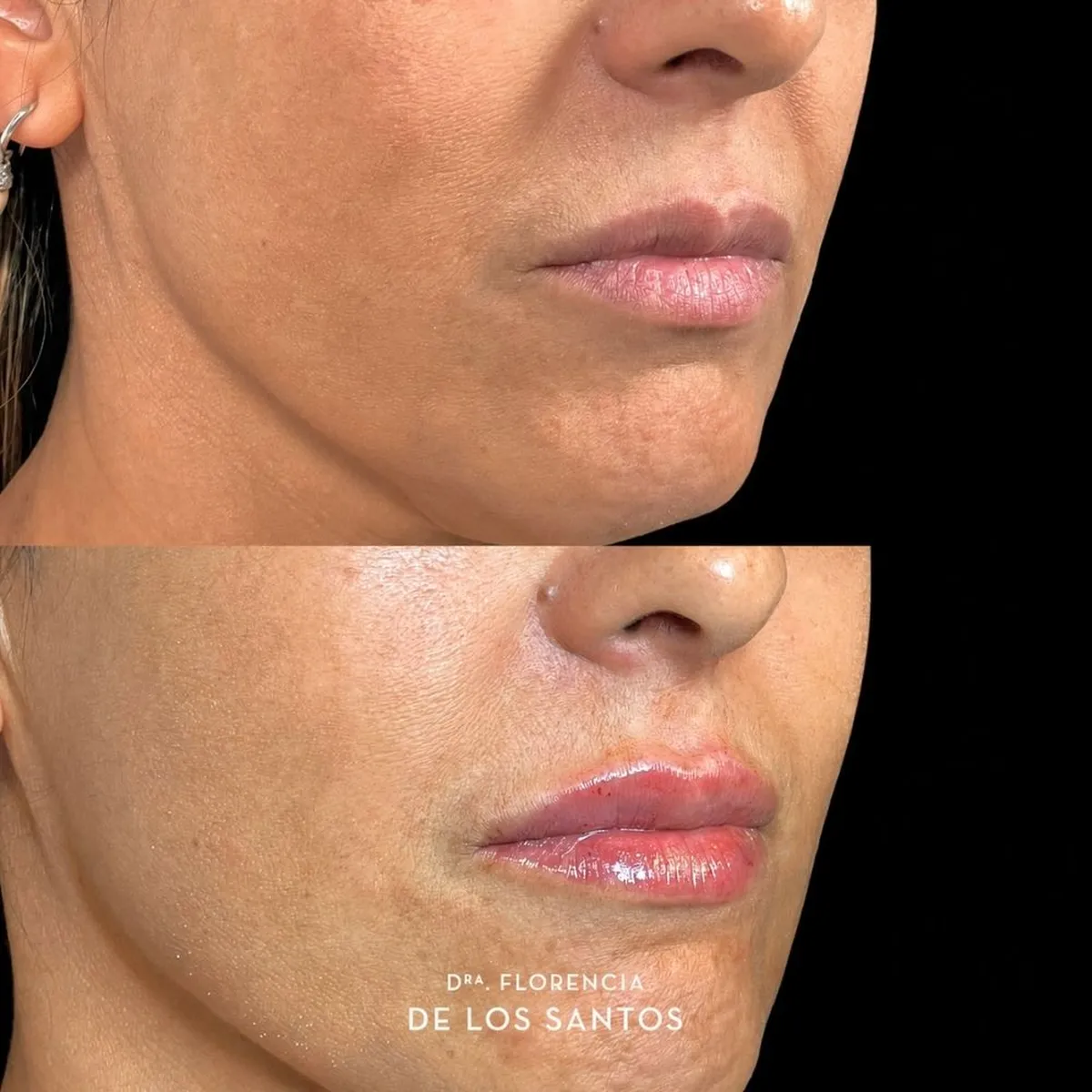 Relleno hidratacion labios Dra Florencia de los Santos Medicliniq1