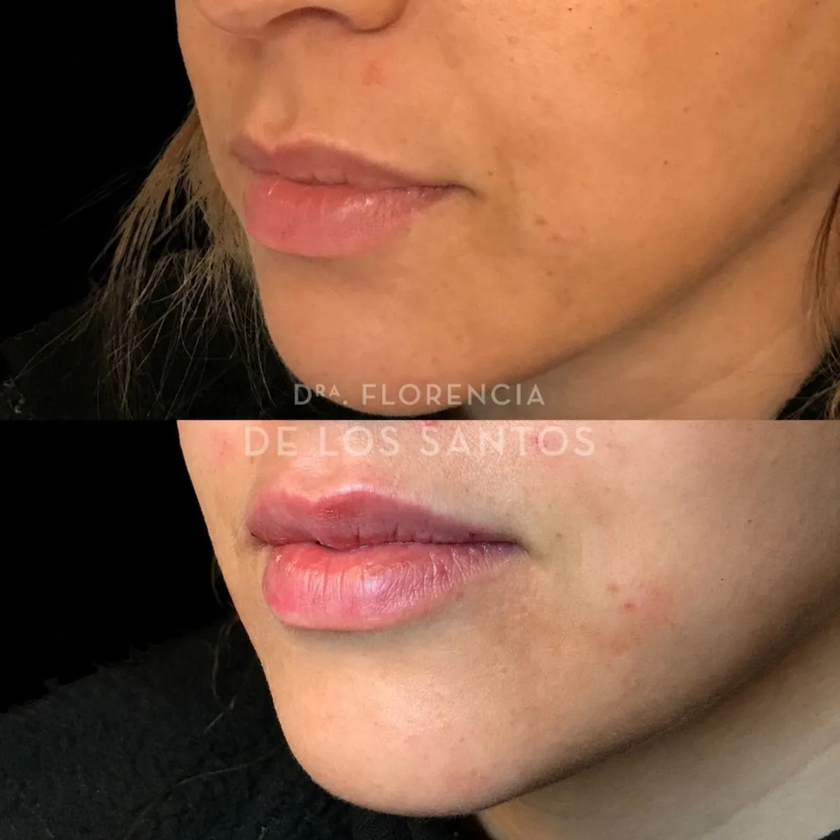 Relleno hidratacion labios Dra Florencia de los Santos Medicliniq11