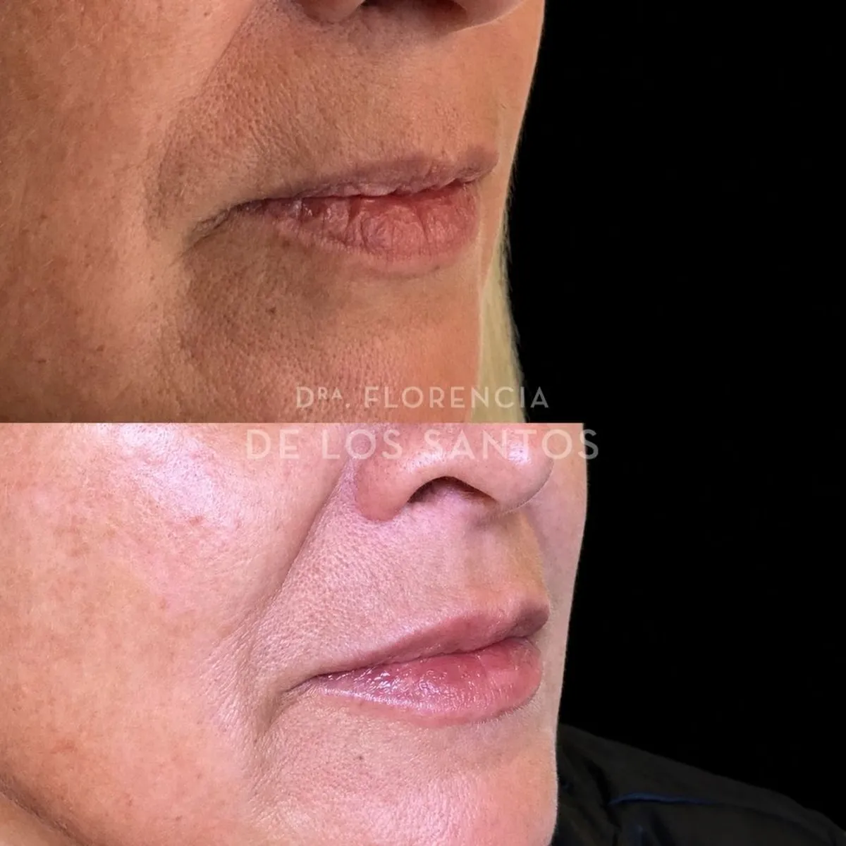Relleno hidratacion labios Dra Florencia de los Santos Medicliniq12