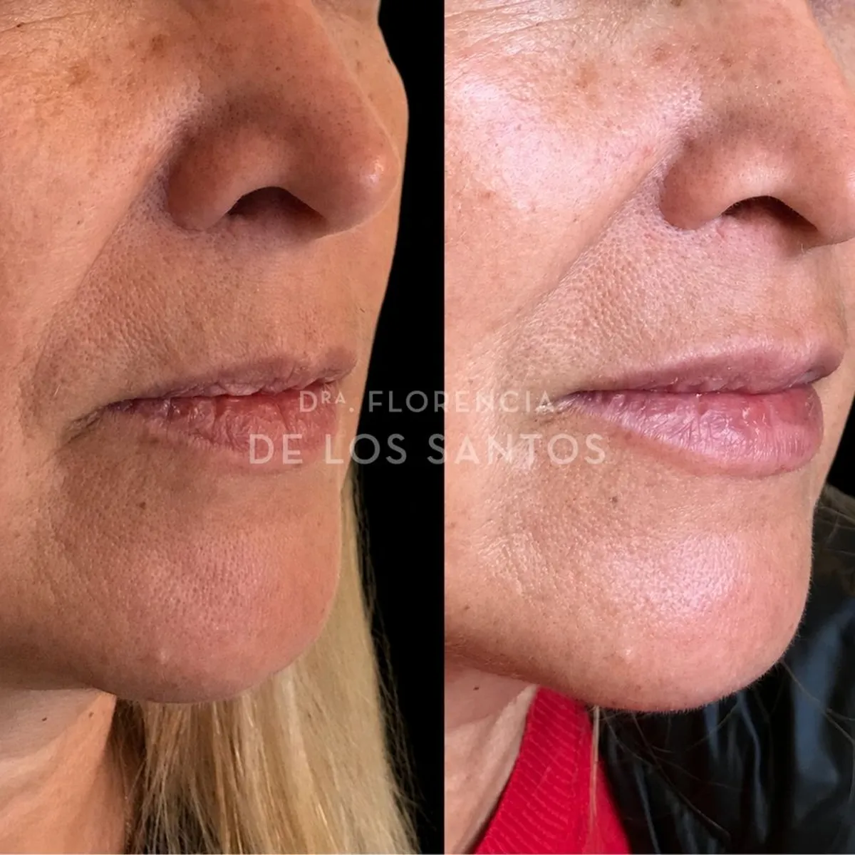 Relleno hidratacion labios Dra Florencia de los Santos Medicliniq13