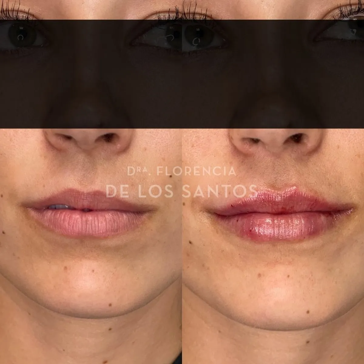 Relleno hidratacion labios Dra Florencia de los Santos Medicliniq14