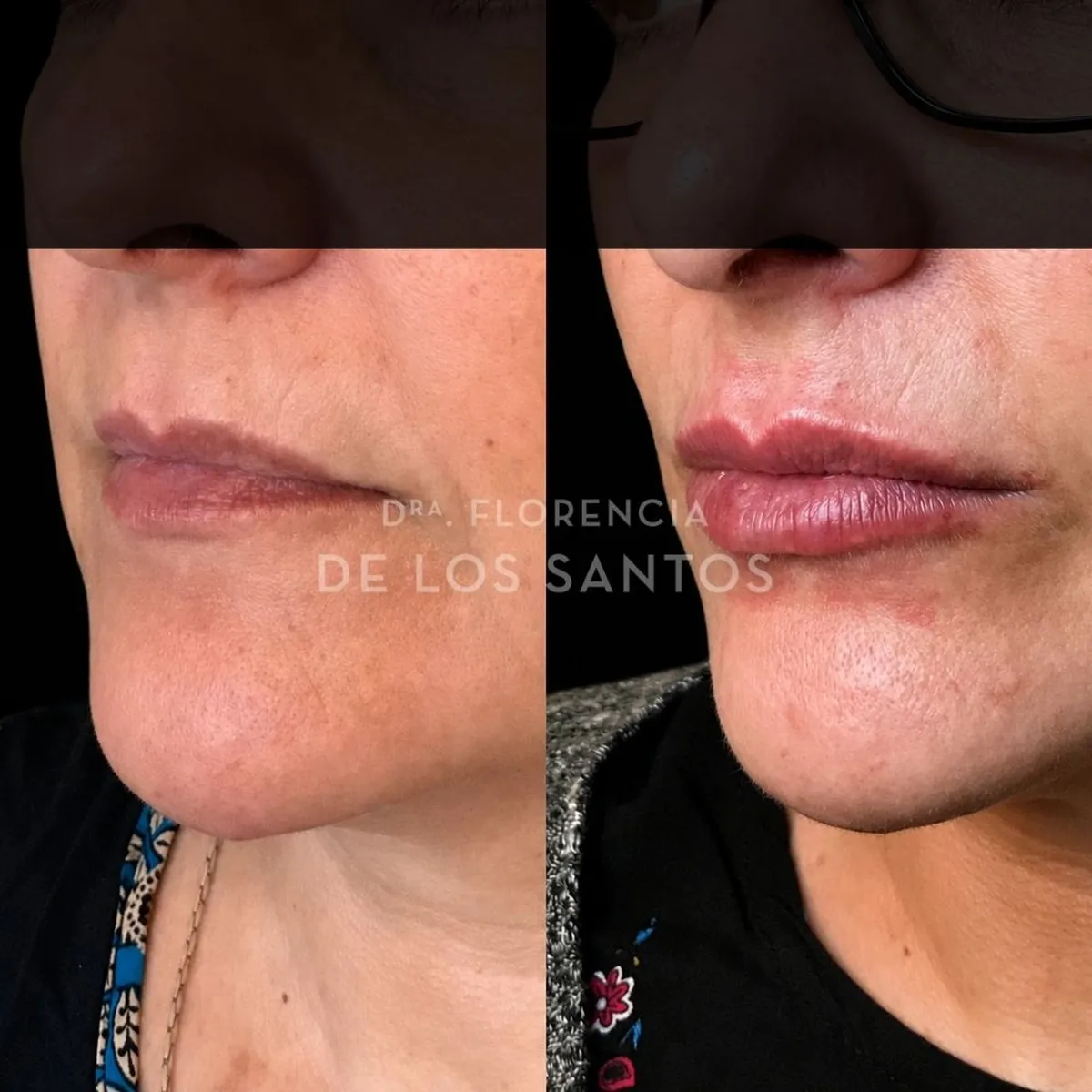 Relleno hidratacion labios Dra Florencia de los Santos Medicliniq15