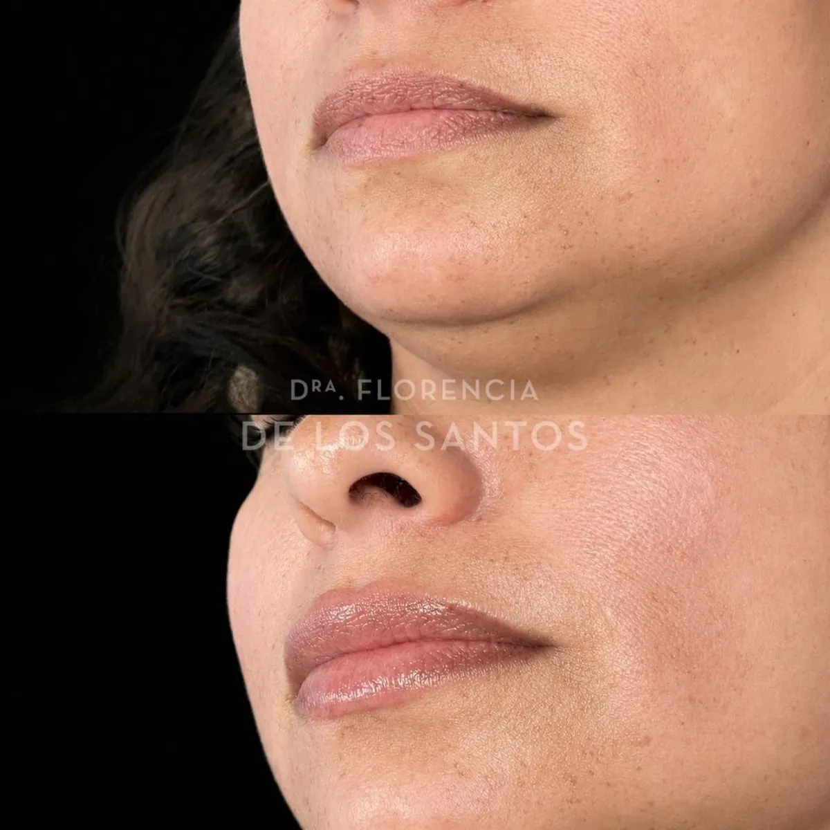 Relleno hidratacion labios Dra Florencia de los Santos Medicliniq16