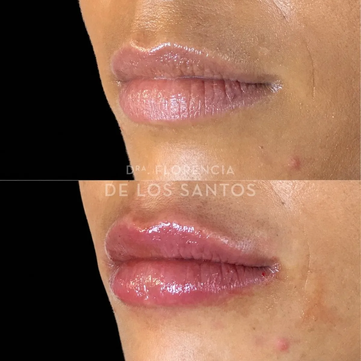 Relleno hidratacion labios Dra Florencia de los Santos Medicliniq17