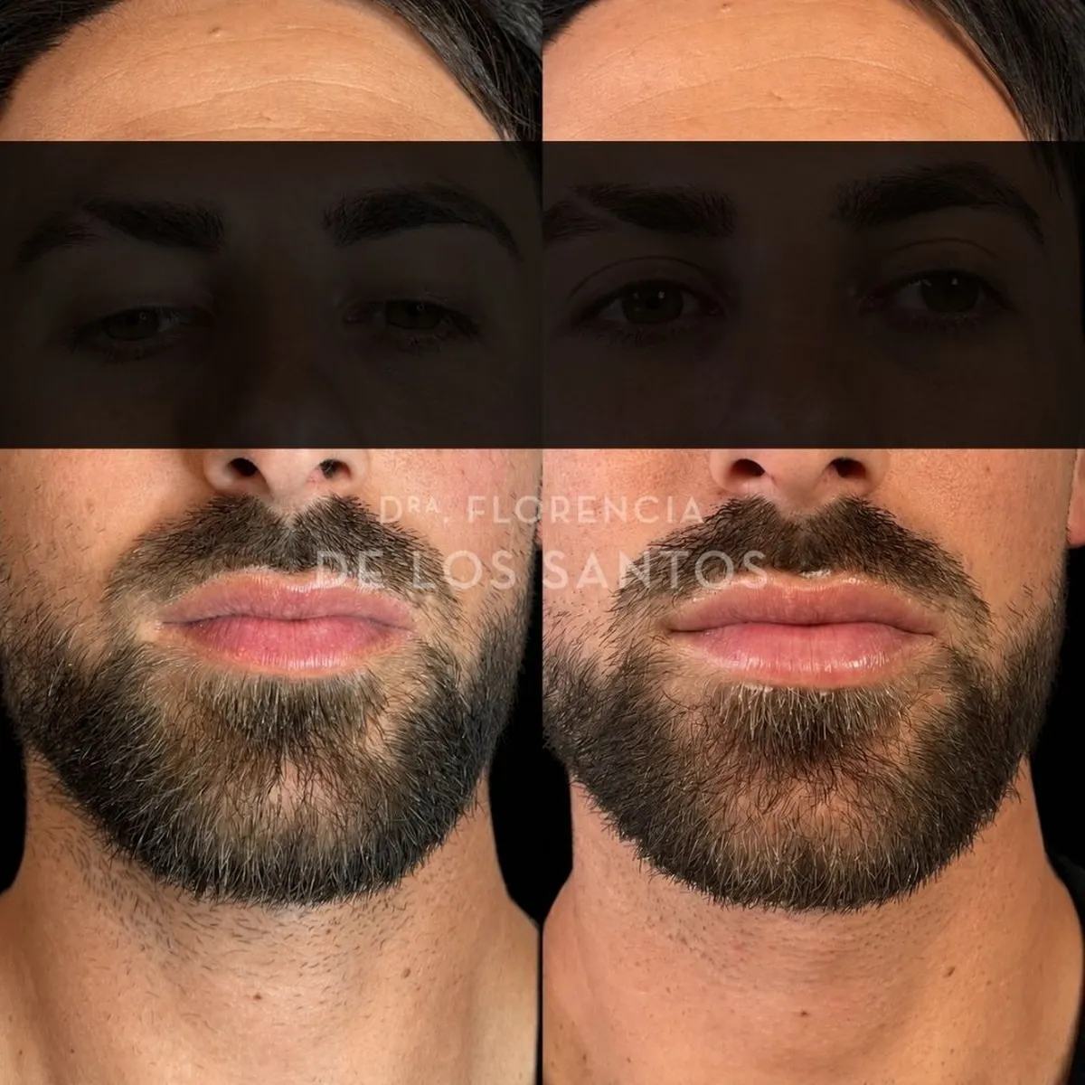 Relleno hidratacion labios Dra Florencia de los Santos Medicliniq2