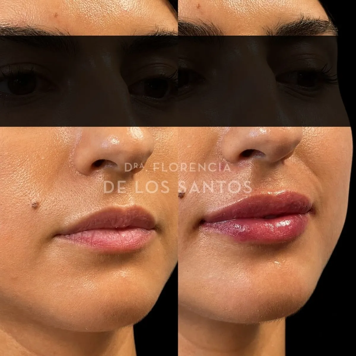 Relleno hidratacion labios Dra Florencia de los Santos Medicliniq3